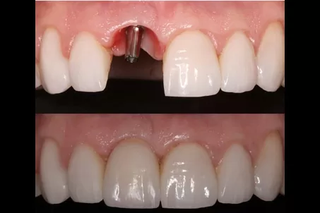 Sorriso Renovado Em Bh Encontre A Melhor Cl Nica De Implante Dent Rio