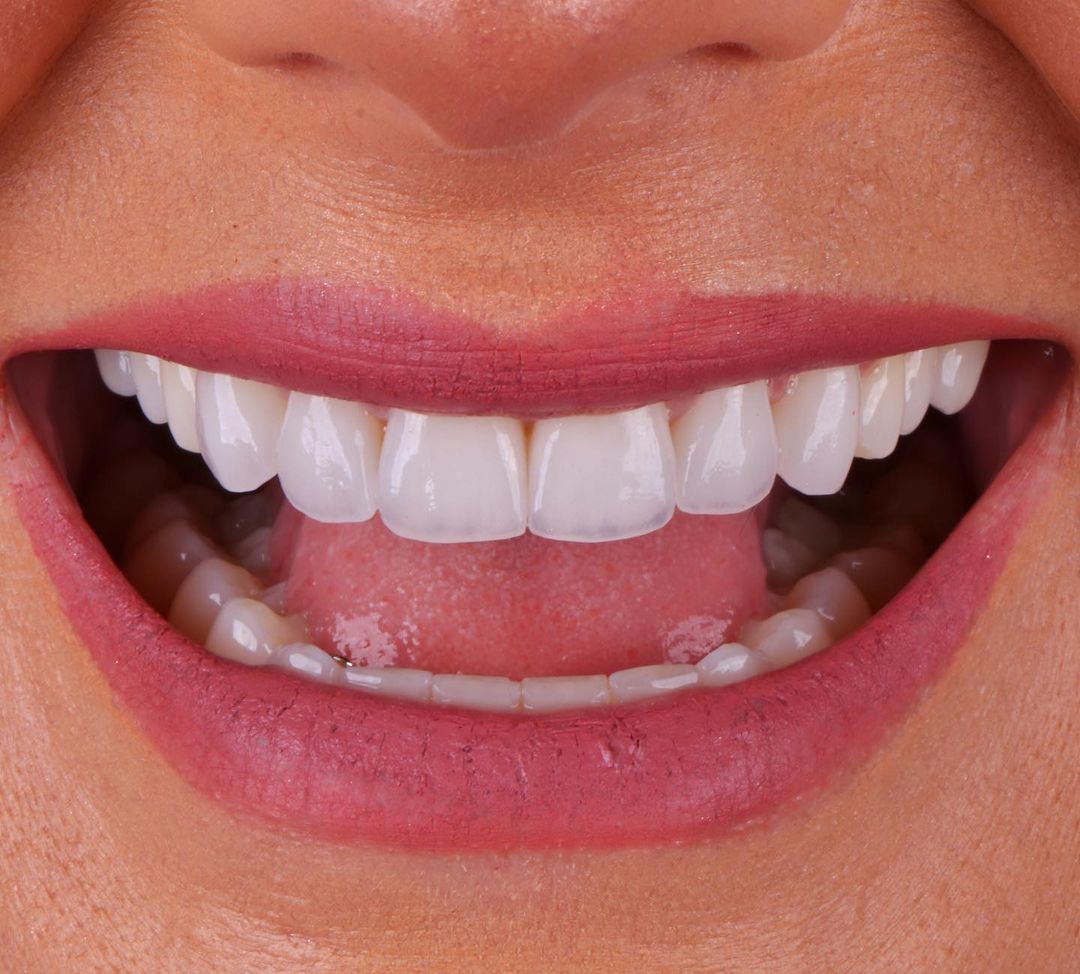 Os Segredos das Lentes de Contato Dentais – Odontoquality