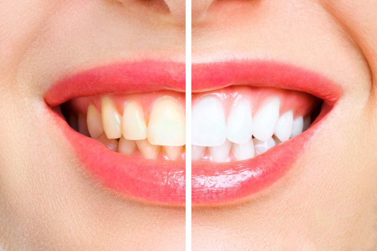 Implante dentário: sorriso para a vida toda! | Clínica odontológica - Do Futuro